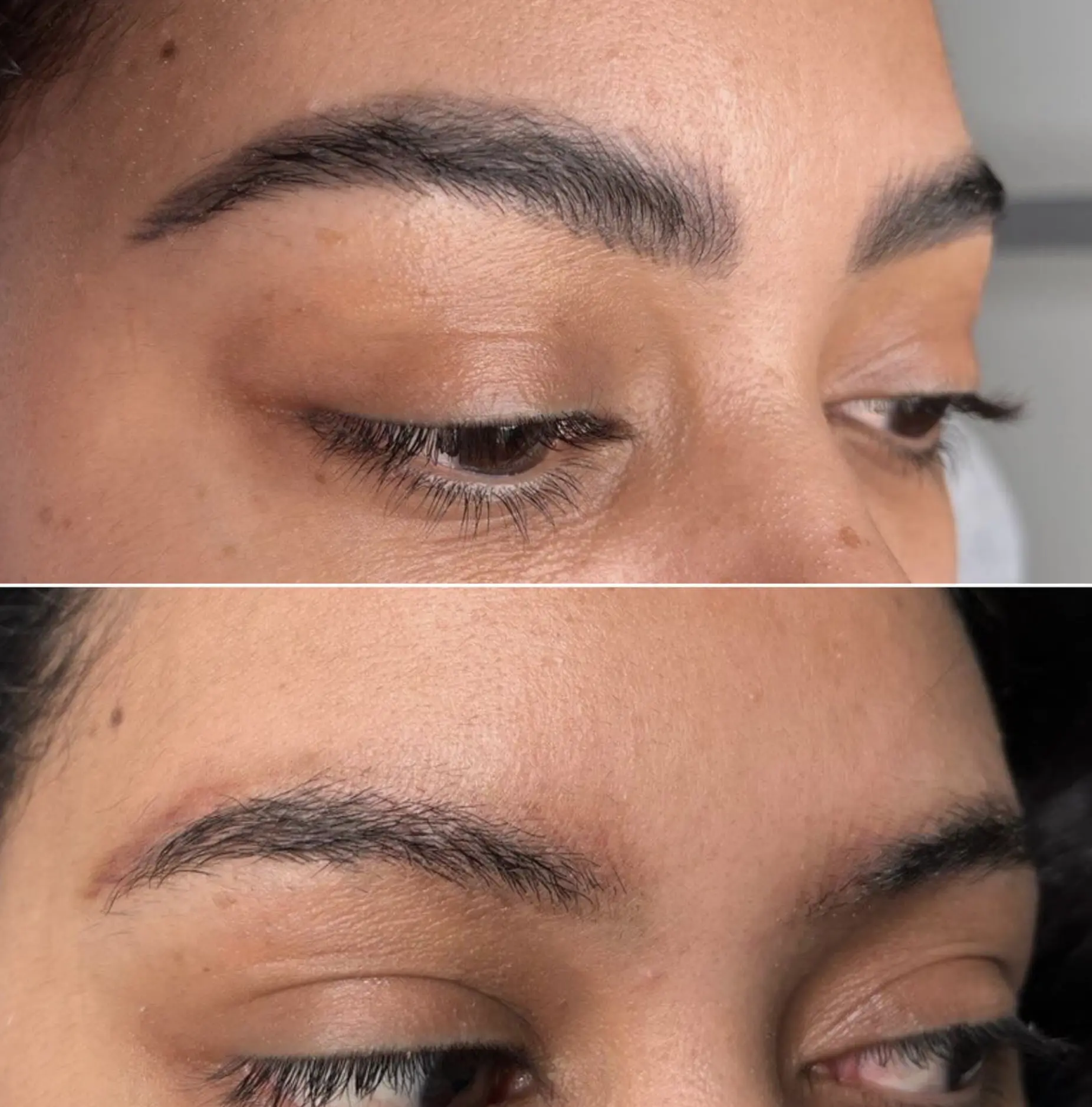 Eyebrow tattoo removal