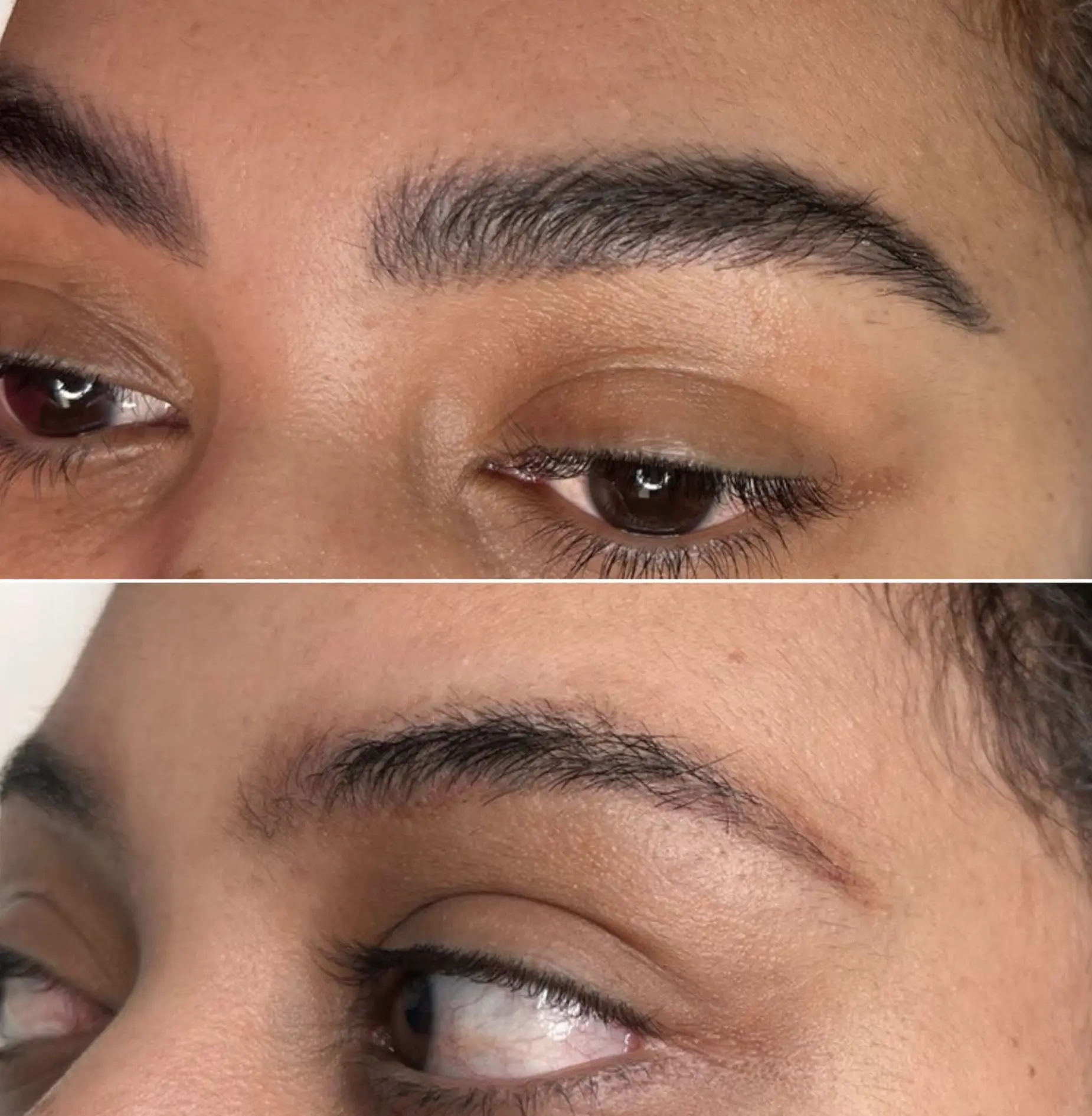 damaged skin from at-home tattoo removal